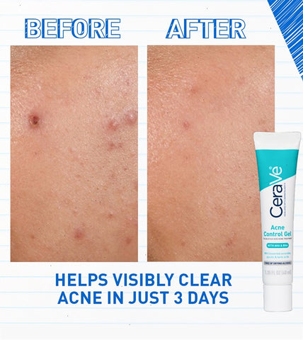 Acne Control Gel